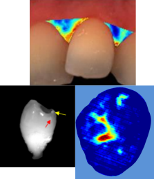 Towards entry "Thesis: Near-IR imaging and ML to estimate tooth & gum status"